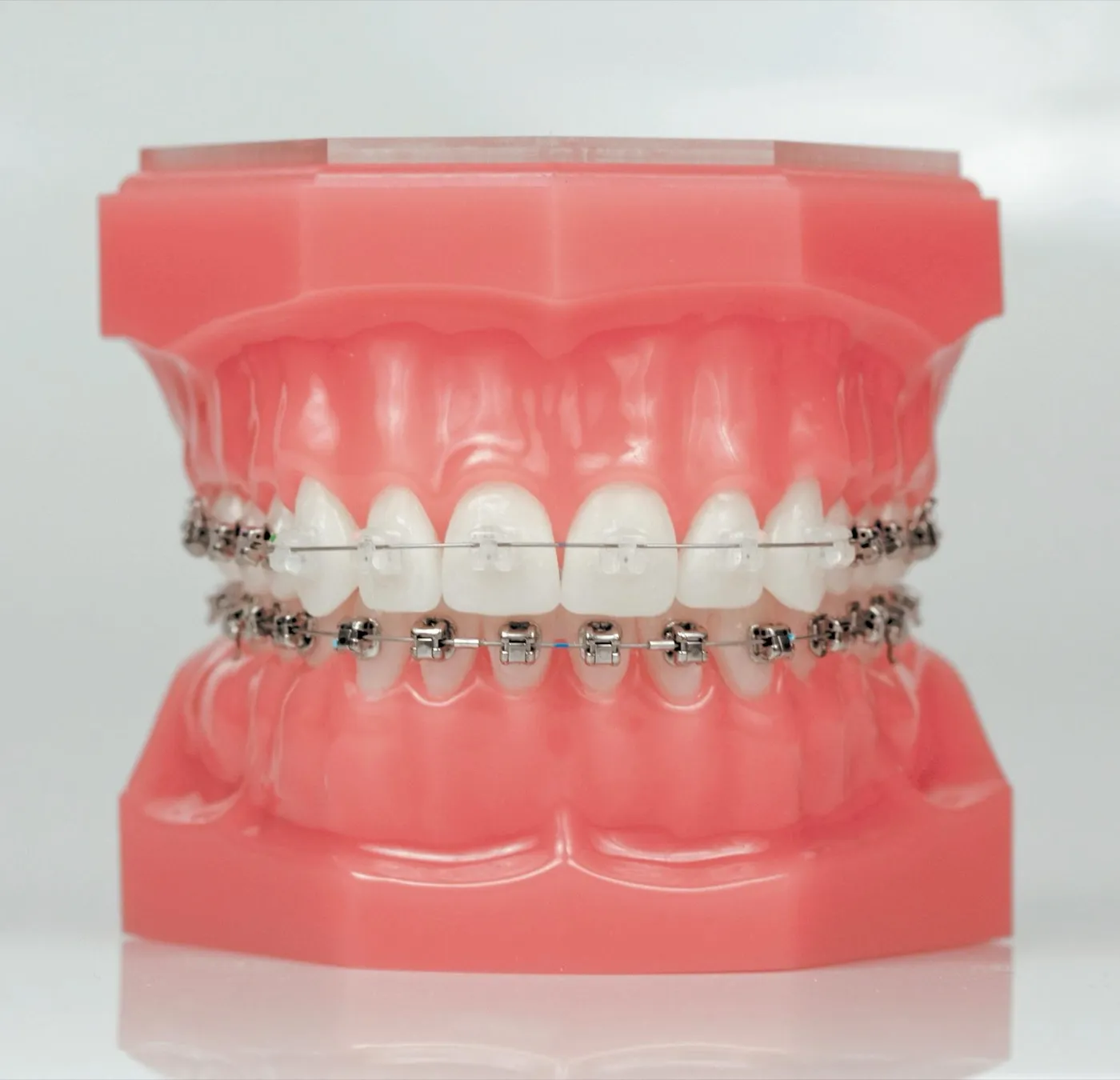 Modelo dental con brackets metálicos en la arcada inferior y brackets estéticos en la superior