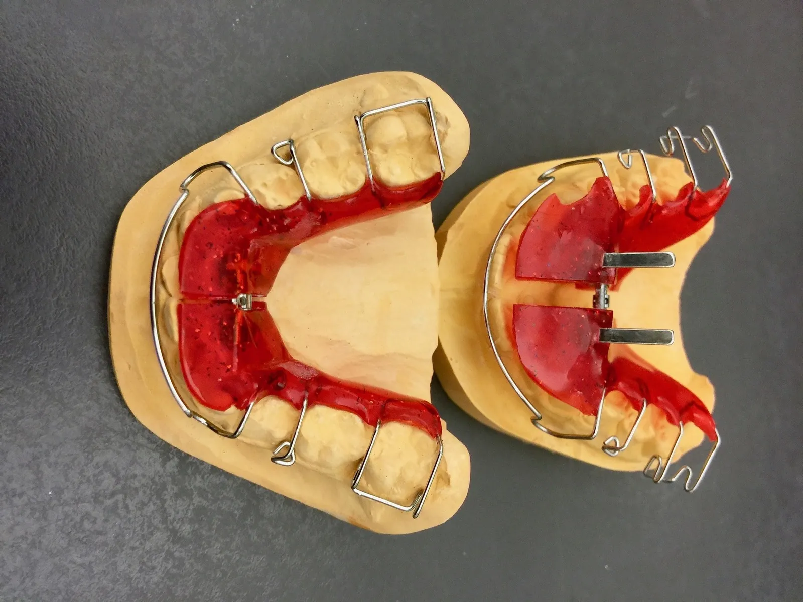 Dos aparatos removibles de ortopedia dentofacial con placa roja sobre modelos de escayola