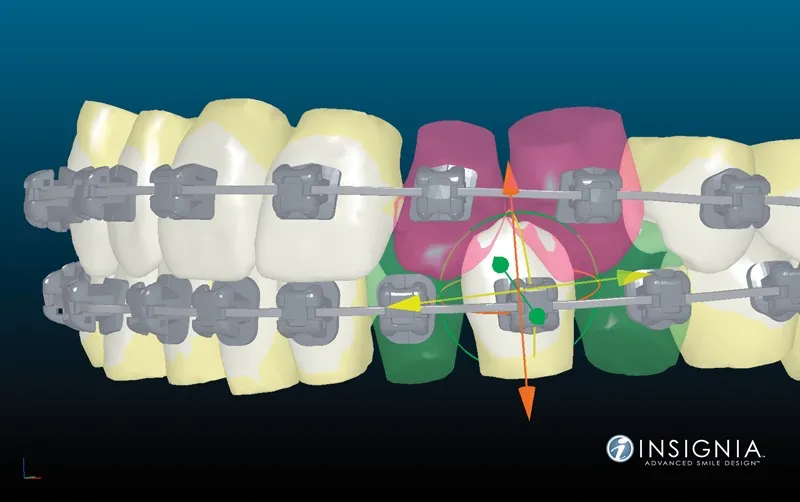 Simulación por ordenador del sistema Insignia con brackets a medida sobre la arcada dental
